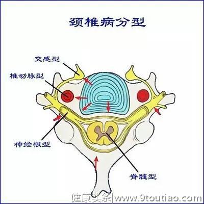 面对颈椎病引起的头晕无力该怎么办？