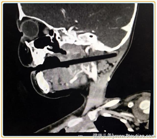 女童跌倒筷子插入口腔10厘米，湘雅专家提醒，谨防儿童意外伤害