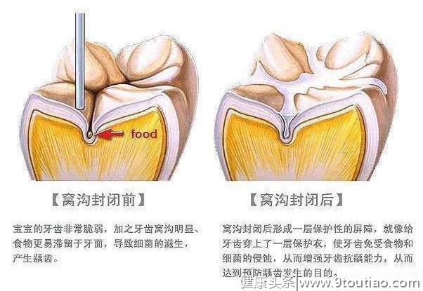 预防儿童龋齿 进行窝沟封闭 我来讲讲操作方法及注意事项