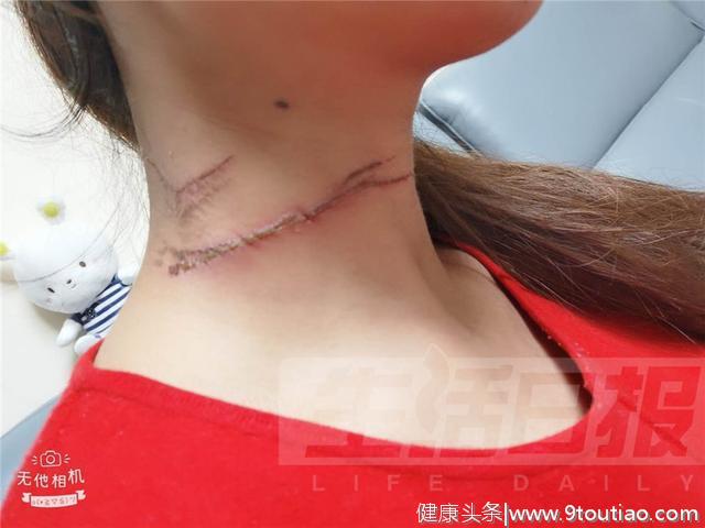 孕妇怀孕8个月遭风筝线割颈，伤口达5厘米！导致她受伤的还是两拨人…