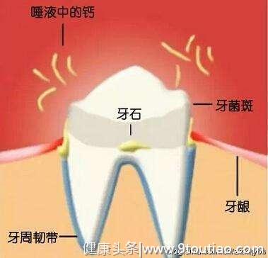 天哪！大多数人都不知道牙结石原来是这样长成的！