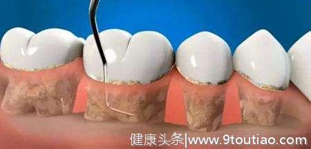 天哪！大多数人都不知道牙结石原来是这样长成的！