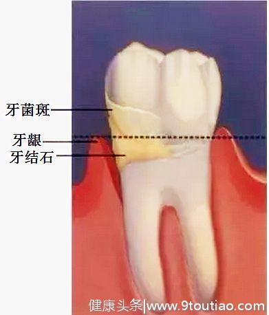 天哪！大多数人都不知道牙结石原来是这样长成的！