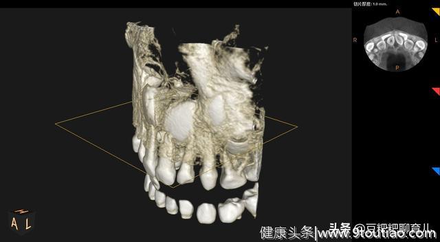 孩子的牙齿疾病之一，越来越多的孩子有“多生牙”，你了解它吗？