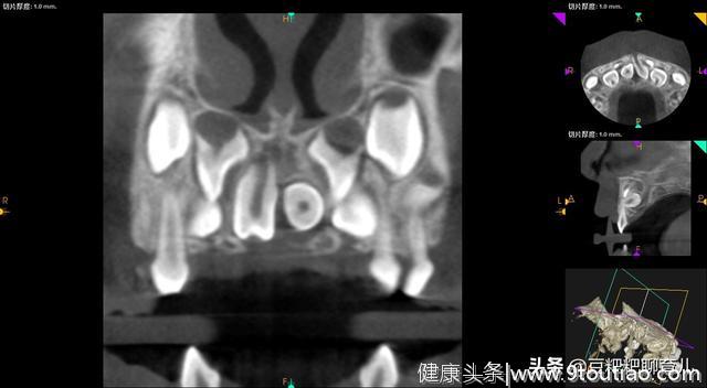 孩子的牙齿疾病之一，越来越多的孩子有“多生牙”，你了解它吗？