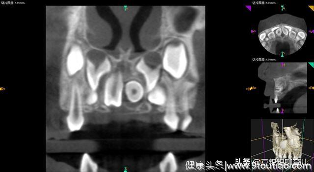 孩子的牙齿疾病之一，越来越多的孩子有“多生牙”，你了解它吗？