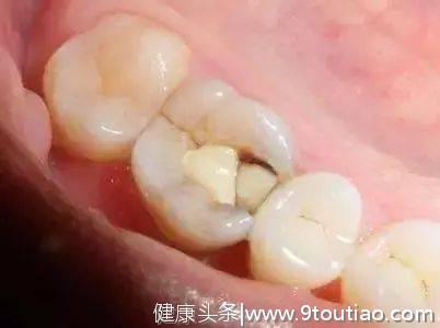 你还在美白你的牙齿？新研究表明：这种行为正悄悄伤害你的牙齿！