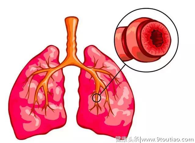 不是所有的哮喘都会喘，胸闷7年最后竟然是哮喘！