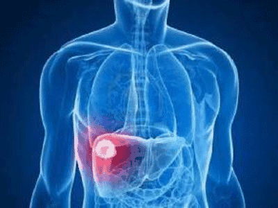 炎症是引起肝癌的关键因素，这种蛋白质可以抗炎减少肝脏炎症
