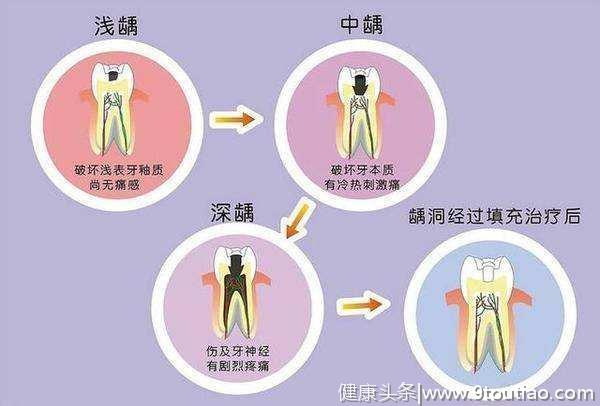 龋齿是怎么引起的？-济宁丁香树口腔