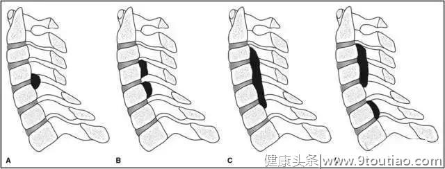 骨科专家说给你听:颈椎后纵韧带骨化是咋回事?需要手术?（原创）