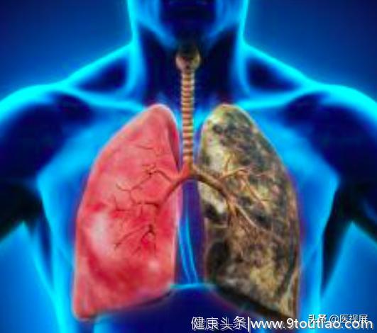肺癌的重大误区—肺癌的典型症状，尽快转告亲人！