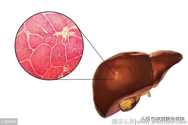 提醒一句：肝硬化要做好4个监测，不要盲目治疗！