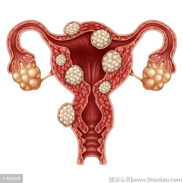 女性子宫肌瘤是“妇科第一瘤”？30岁以上女性一定要看看这篇文章