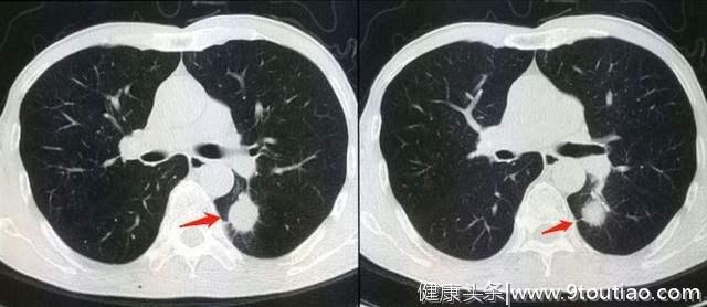 肺部CT只能诊断肺癌吗？答案远非如此！