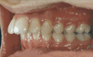 牙齿矫正一年可以完成吗？