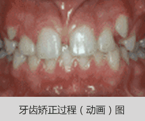 牙齿矫正一年可以完成吗？