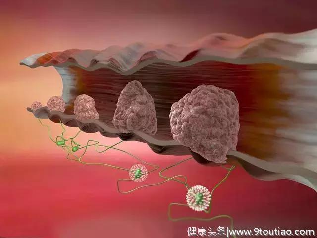 53岁男子，肠癌晚期，医生提醒：这3类人，出现2痛1多，及时检查