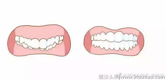 如何判断自己是骨性龅牙还是牙性龅牙？出现龅牙该怎么治疗？