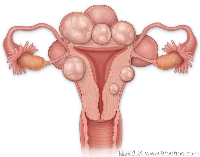 子宫肌瘤是不孕元凶，育龄女性少吃这些食物