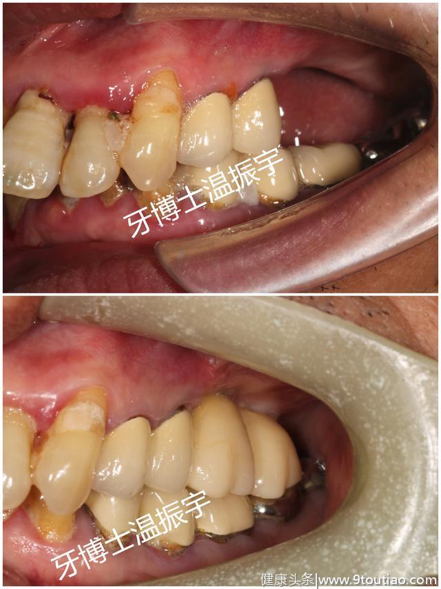 补上的牙齿能用一辈子吗？