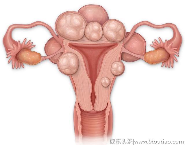 子宫肌瘤莫吃错，地雷食物少碰，要忌口