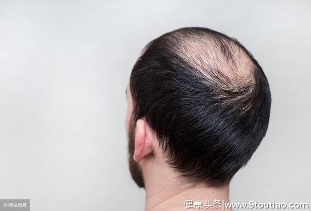 每6人就有1人脱发？脱发是怎么引起的？如何拯救日渐稀少的头发？