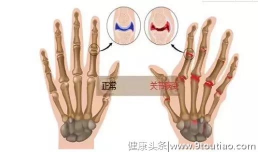 一文读懂类风湿关节炎的相关检测