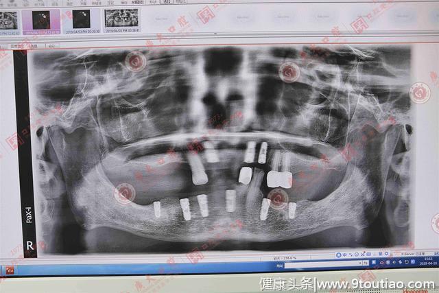 短篇|巴西名医克拉林多博士和这位广州老人的一段故事