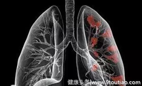 老汉从不吸烟，确诊肺癌，医生：手指的一种变化是肺癌提示信号！