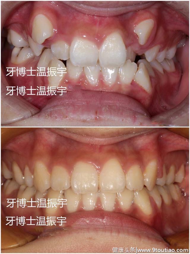 30岁了，还能做牙齿矫正吗？