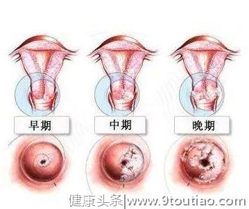 中国宫颈癌高发 宫颈癌疫苗你知道吗 我来告诉你宫颈癌那些事