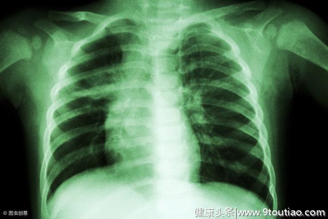 肺结核会变成肺癌吗？什么症状时警惕肺结核和肺癌并存