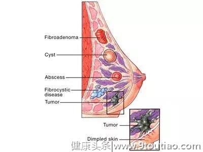 晚婚晚育、频繁做人流手术……这样的你，乳腺癌表示有点稀罕……