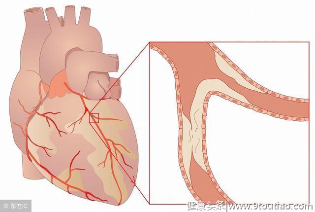 冠心病患者，为什么经常要吃阿司匹林和降脂药？