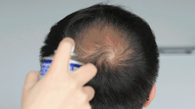 秃顶已经成为中国人的噩梦，脱发真的无药可救吗？