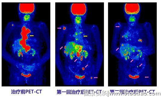 身患骨癌怎么办？医生提醒：你需要掌握这7个知识点！