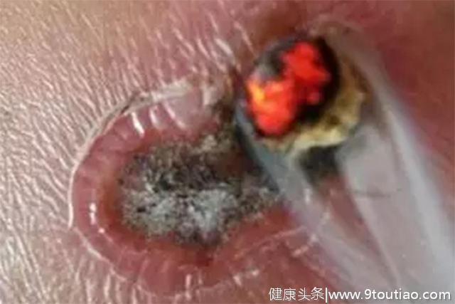 中医二羊：古法艾灸化脓灸实践录，慢性胃炎阳虚怕冷没了