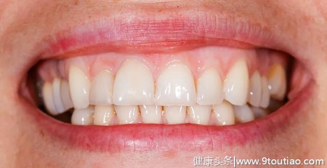 牙龈为啥会出血？牙医推荐这3种方法，简单好用