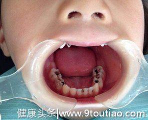 宝宝蛀牙，该不该修补？
