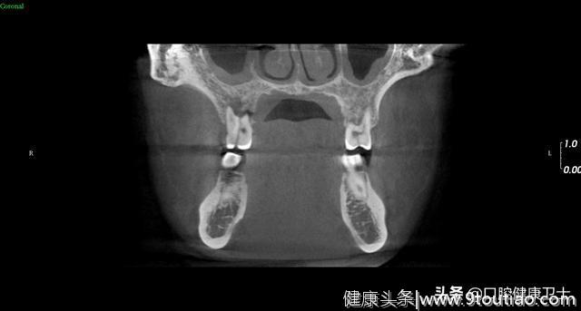 牙齿劈裂怎么办？一例劈裂患牙的拔除。