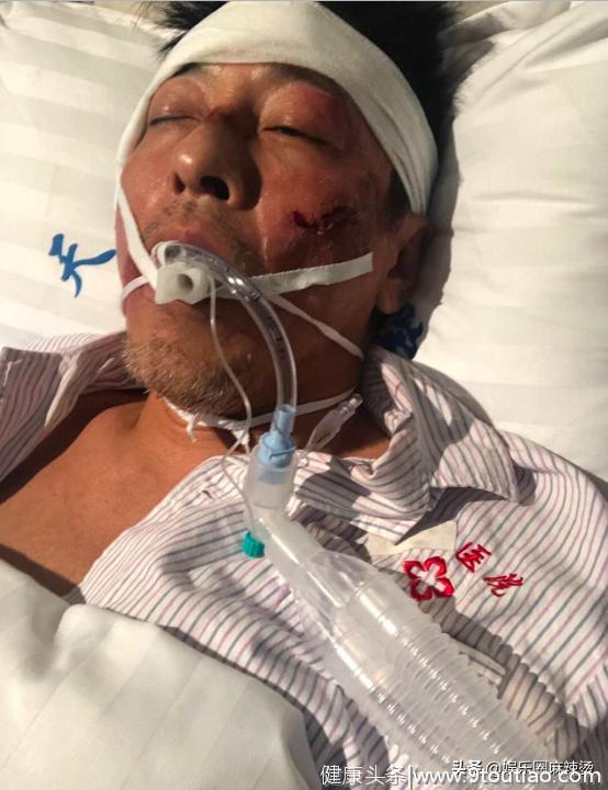 港星吕颂贤曝“医院急救”照片，口腔塞满了吸氧气管，吓坏了网友