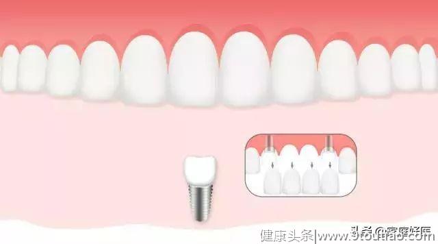 牙齿变长牙缝变宽……注意！你的牙龈正在萎缩！