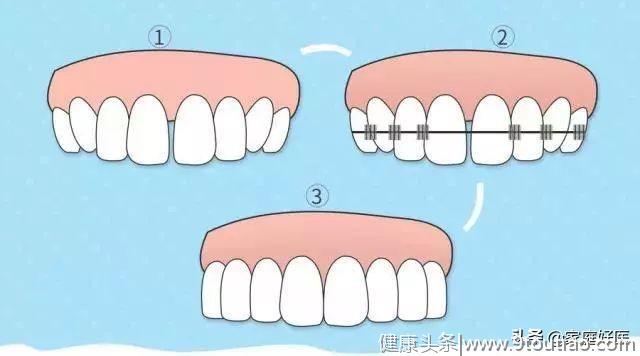 牙齿变长牙缝变宽……注意！你的牙龈正在萎缩！