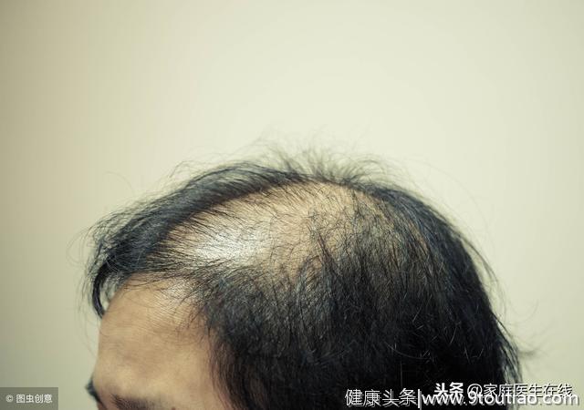 中年男性为何“爱”脱发？原因不外乎这4个，难解决