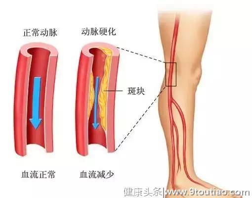 糖友如此“腿疼”可不是关节炎，是血管出了大问题！