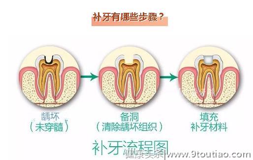 补牙到底补的是什么？最新补牙流程图，带你了解补牙真相