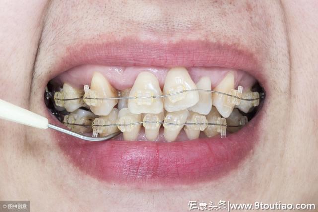 补牙到底补的是什么？最新补牙流程图，带你了解补牙真相