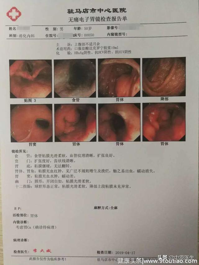 男子腹胀怕做胃镜，被查出胃癌