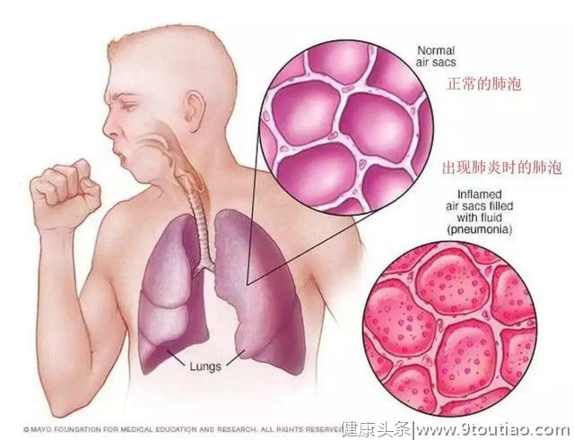 孩子是肺炎还是感冒？看这 3 点最靠谱